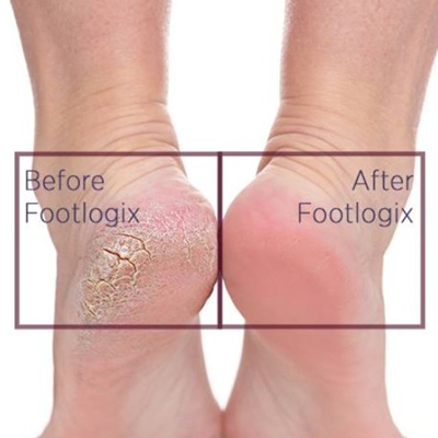 Footlogix Callus Feet Treatments in Holywood, Belfast