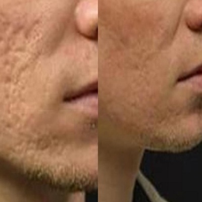 Acne scarring treatments at Karma Holywood Salon Acne scarring treatments at Karma Holywood Salon