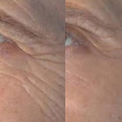 Beat wrinkles with RF Microneedling at Karma Beauty Salon Holywood Beat wrinkles with RF Microneedling at Karma Beauty Salon Holywood