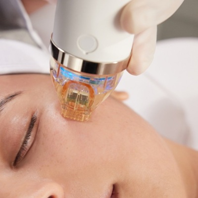 CUTERA RF MICRONEEDLING AT KARMA BEAUTY SALON HOLYWOOD CUTERA RF MICRONEEDLING AT KARMA BEAUTY SALON HOLYWOOD