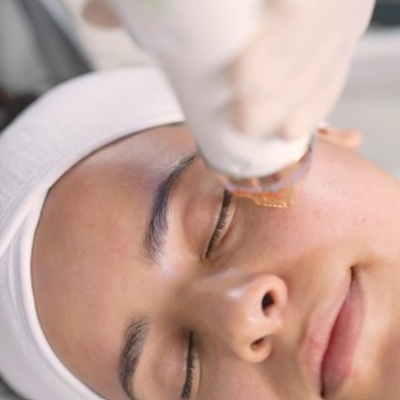 Cutera laser treatments for younger skin Belfast Salon