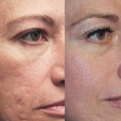 Improve skin texture with RF Microneedling in Holywood Improve skin texture with RF Microneedling in Holywood