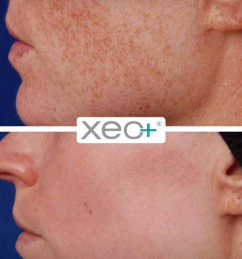 Laser Genesis for Clear Skin at Karma Holywood Salon Laser Genesis for Clear Skin at Karma Holywood Salon