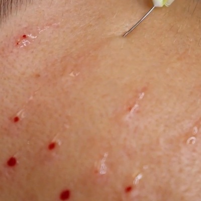 Mesotherapy treatments at Karma Beauty Salon near Belfast Mesotherapy treatments at Karma Beauty Salon near Belfast