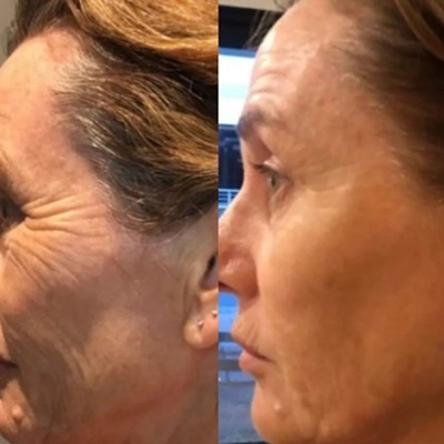 RF Microneedling Before & After in Belfast RF Microneedling Before & After in Belfast