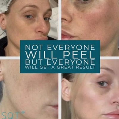 SQT Bio Microneedling in Holywood, Belfast