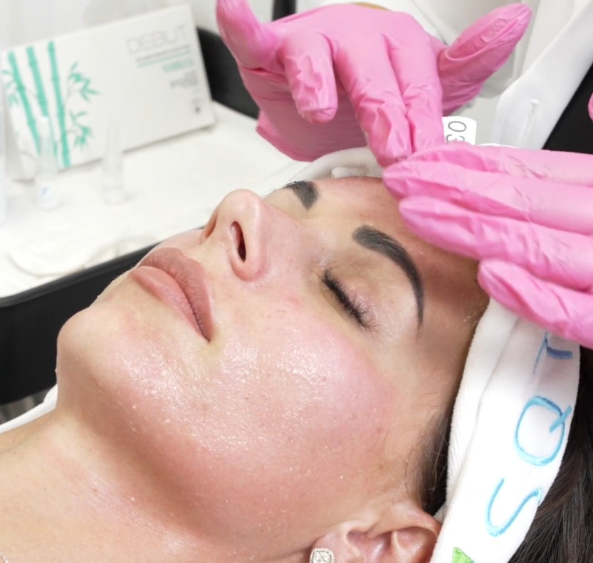 Sqt bio microneedling anti ageing treatments in Belfast