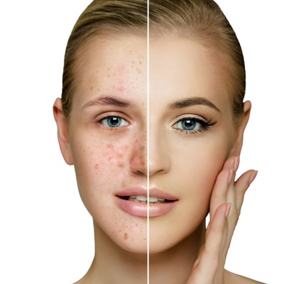 acne treatments at Karma Skin Clinic in Holywood