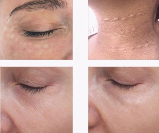 before and after mesotherapy karma holywood salon before and after mesotherapy karma holywood salon