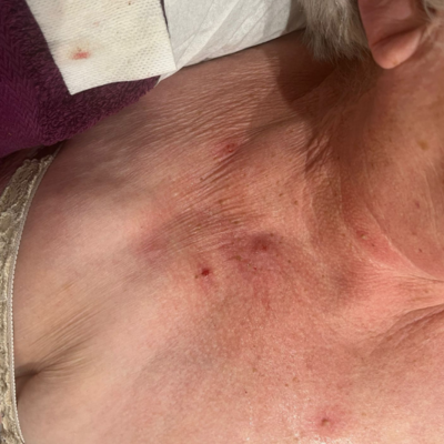 thread vein and blemish removal in Holywood