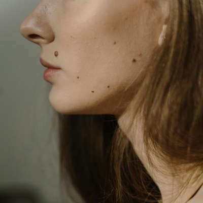 blemish removal at Karma Skin Clinic in Holywood