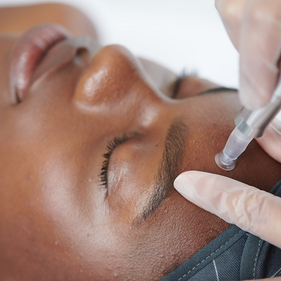 dermalogica pro microneedling at BEST SKIN CLINIC IN BELFAST