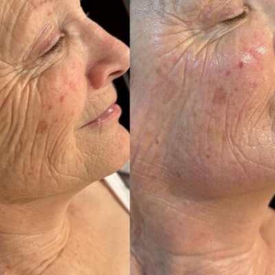 rf microneedling anti ageing treatments in Holywood, Belfast rf microneedling anti ageing treatments in Holywood, Belfast