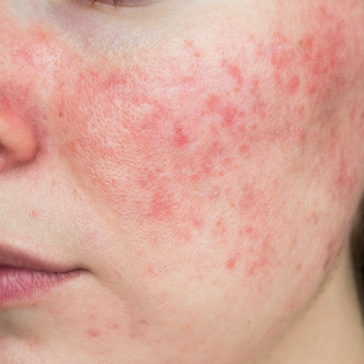 Sensitive skin treatments in Belfast