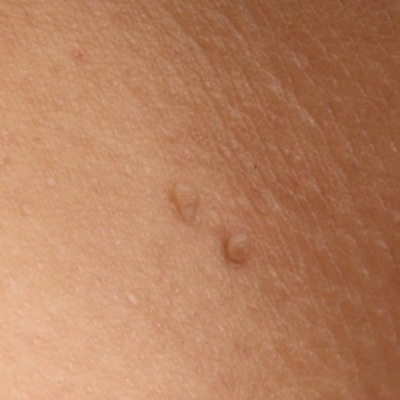 skin tag removal at Karma Salon in Holywood, Belfast