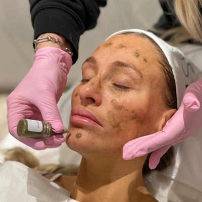 sqt bio microneedling at Karma Beauty Salon in Holywood