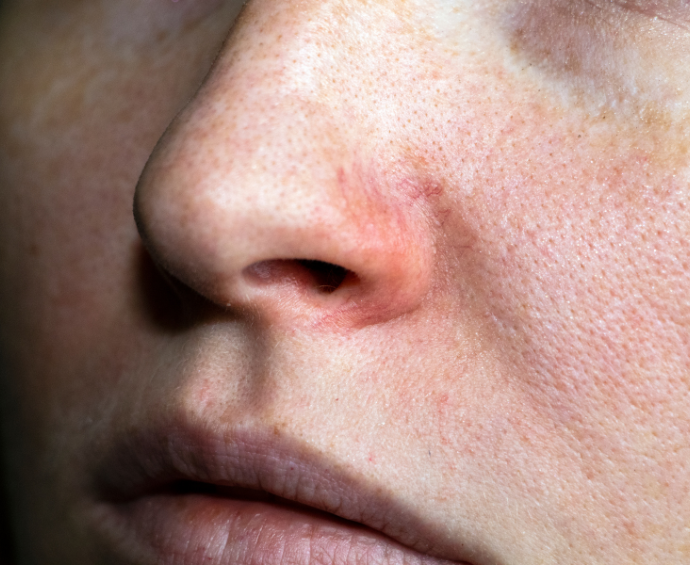 thread vein removal at Karma Skin Clinic in Holywood