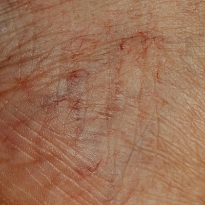 thread vein removal at Karma Beauty Salon in Holywood