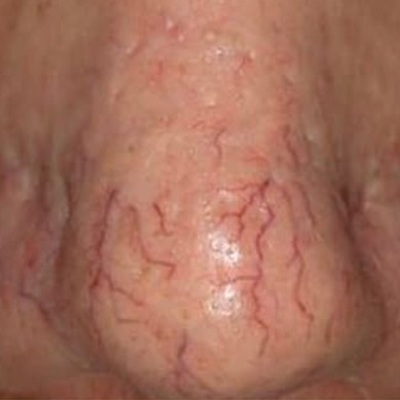 thread vein removal at best skin clinic in Holywood, Belfast